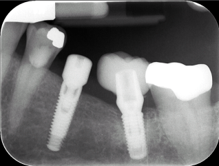 implant20